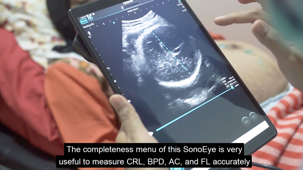 SonoEye Story | SonoEye Journey With Midwife In Indonesia
