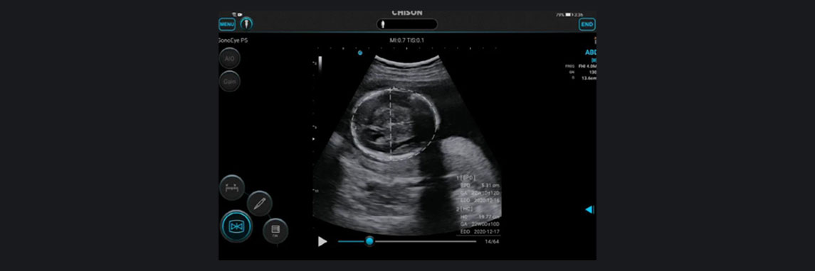 CHISON SonoEye 的愿景是增强女性健康。