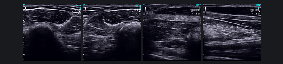 MSK 的 SonoEye
