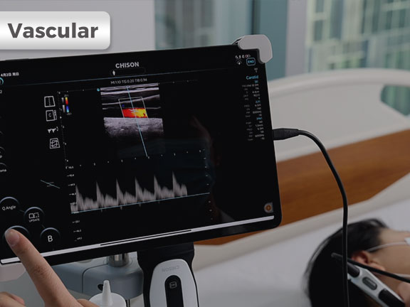 SonoEye in Vascular Ultrasound