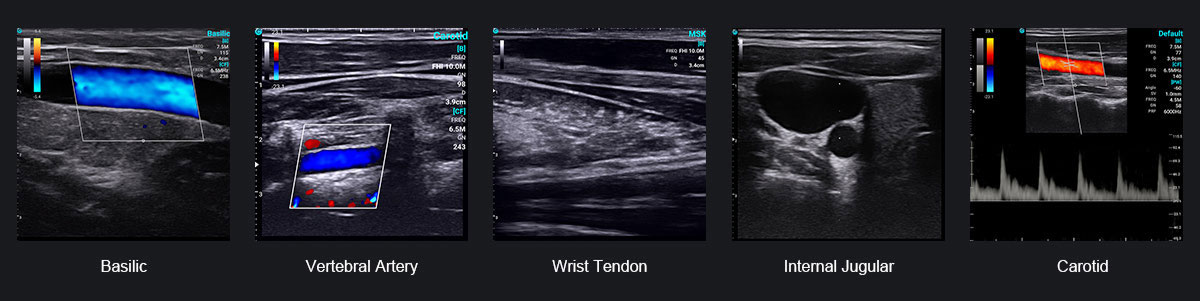 The Point-of-Care Ultrasound (POCUS) Revolution